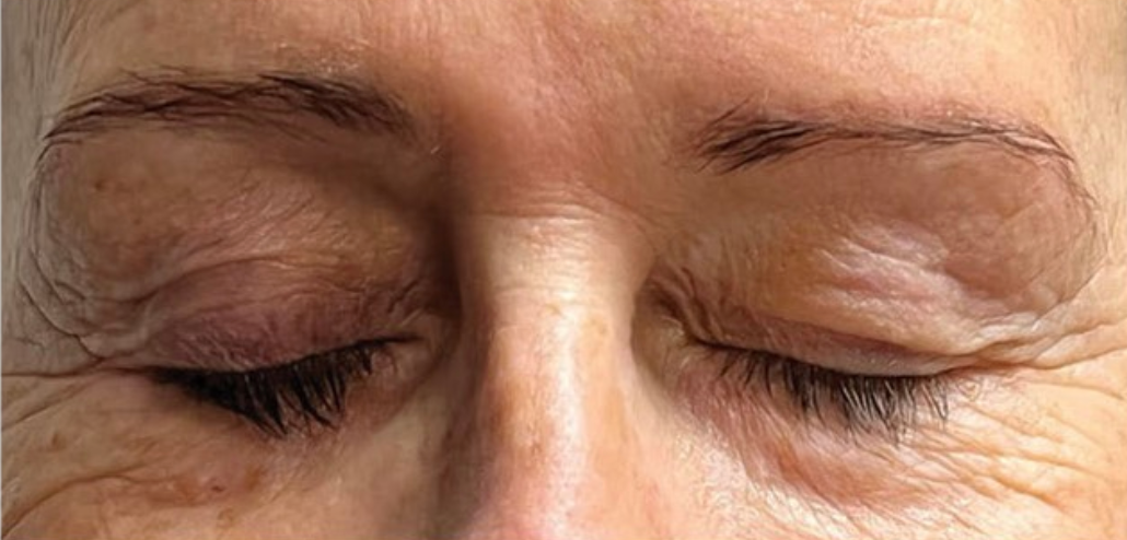 Why Lash Serums Can Cause Dark Eyelids